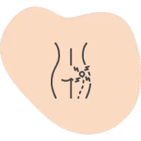 Sciatica